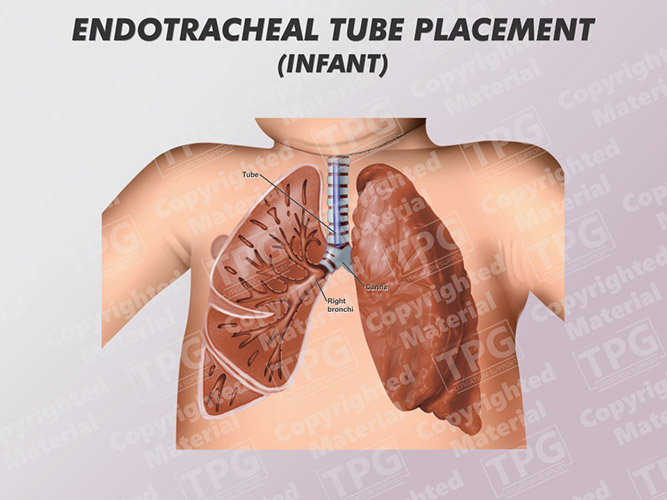 Endotracheal Tube Placement Infant The Presentation Group