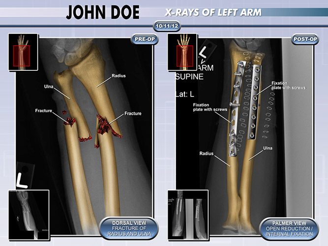 Colorized Diagnostic Films Colorized Fracture Films - The Presentation Group - Trial Exhibits - Medical Illustrations