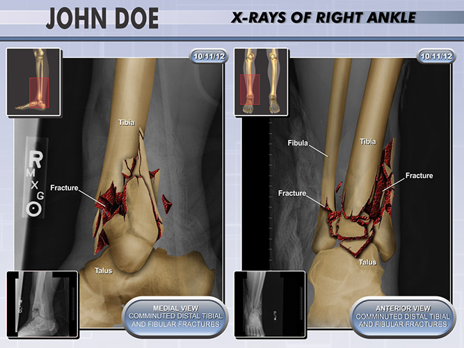 Colorized MRI Films - The Presentation Group - Leg Fractures