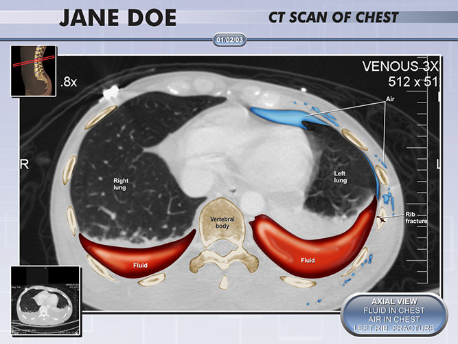 Colorized Diagnostic CT Chest - The Presentation Group - Demonstrative Exhibits