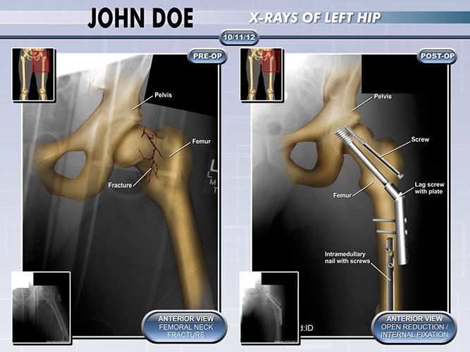 Colorized Hip X Ray - The Presentation Group - Demonstrative Aid for Trial