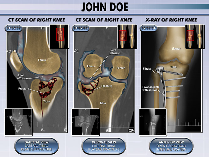 Colorized MRI Films - The Presentation Group - Trial Exhibits - Radiology Exhibits