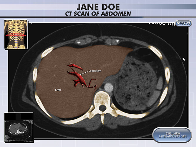 Colorized Diagnostic Films Colorized CT Abdomen - The Presentation Group - Trial Attorney Exhibits - Demonstrative Aid