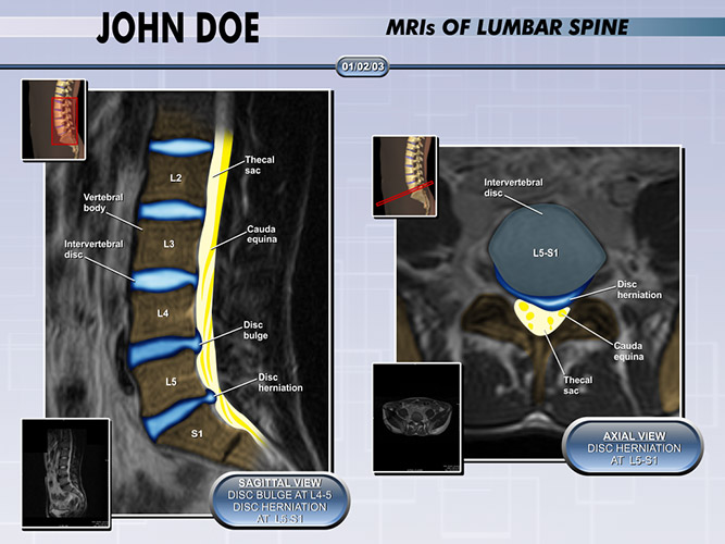 Lumbar Colorized MRI - The Presentation Group - Spine