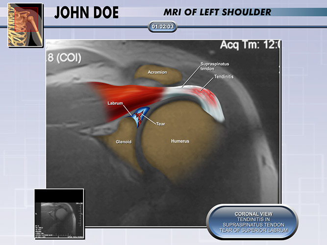 Colorized Diagnostic Films Colorized Films - The Presentation Group - Shoulder