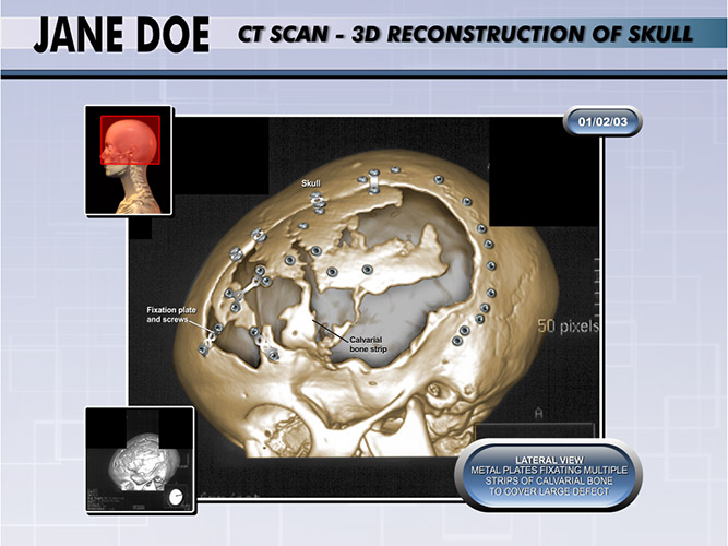 Colorized Diagnostic Films 3d Colorized CT - The Presentation Group - 3D Trial Exhibits