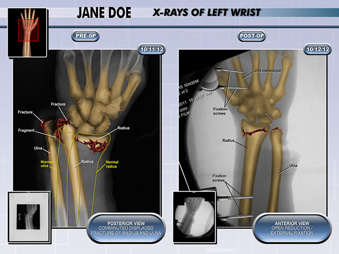 Colorized X-ray Hand - The Presentation Group - Trial Lawyer Exhibits - Litigation Support