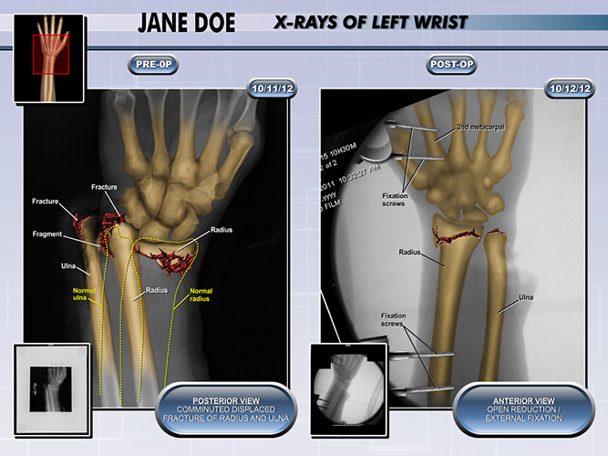 Colorized Diagnostic Films Colorized X-ray Hand - The Presentation Group - Trial Lawyer Exhibits - Litigation Support