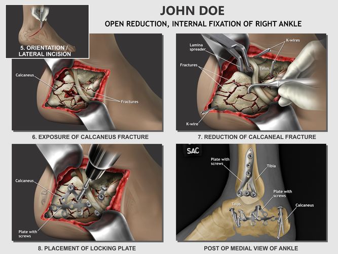 open-reduction-internal-fixation-of-ankle-web Presentation Group - Litigation Support